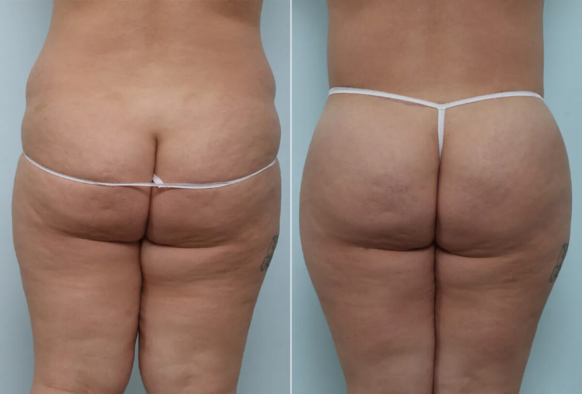 Body Lift before and after photos in Houston, TX, Patient 70580