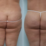 Body Lift before and after photos in Houston, TX, Patient 70580