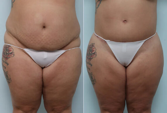 Body Lift before and after photos in Houston, TX, Patient 70580