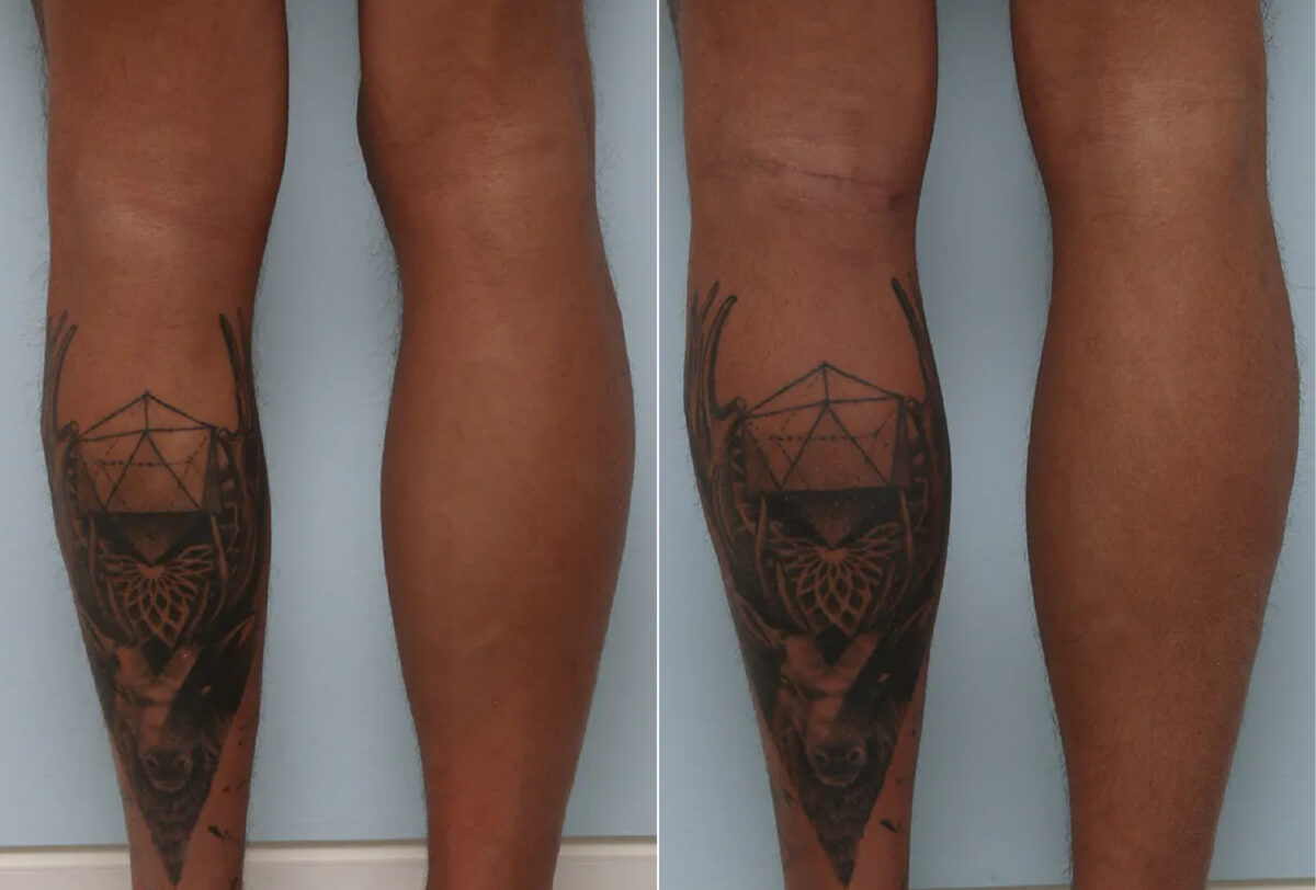 Calf Implants before and after photos in Houston, TX, Patient 70599