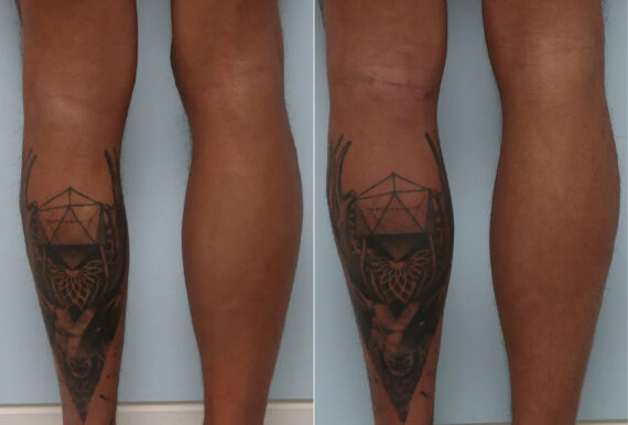 Calf Implants before and after photos in Houston, TX, Patient 70599