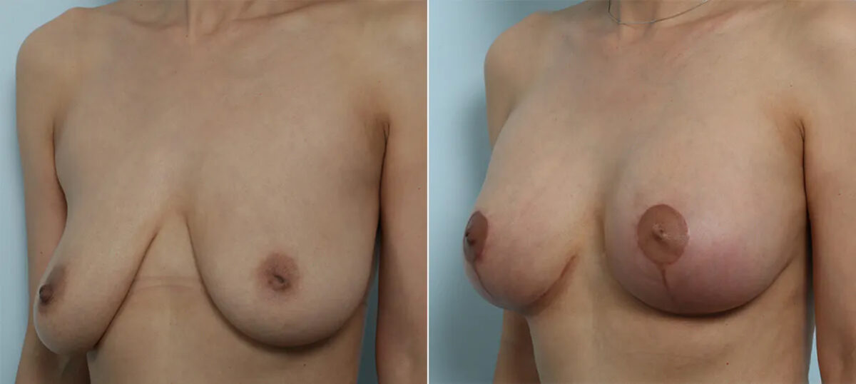 Breast Augmentation-Mastopexy before and after photos in Houston, TX, Patient 70608