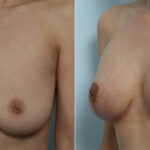 Breast Augmentation-Mastopexy before and after photos in Houston, TX, Patient 70608