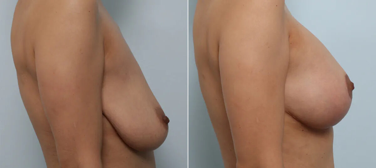 Breast Augmentation-Mastopexy before and after photos in Houston, TX, Patient 70608