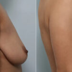 Breast Augmentation-Mastopexy before and after photos in Houston, TX, Patient 70608