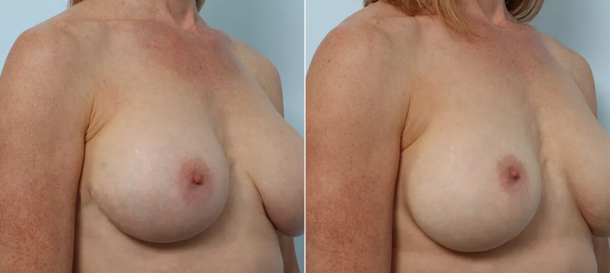 Breast Implant Exchange before and after photos in Houston, TX, Patient 70621