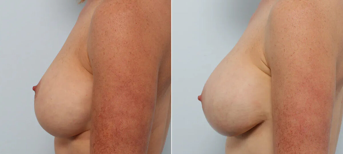 Breast Implant Exchange before and after photos in Houston, TX, Patient 70621