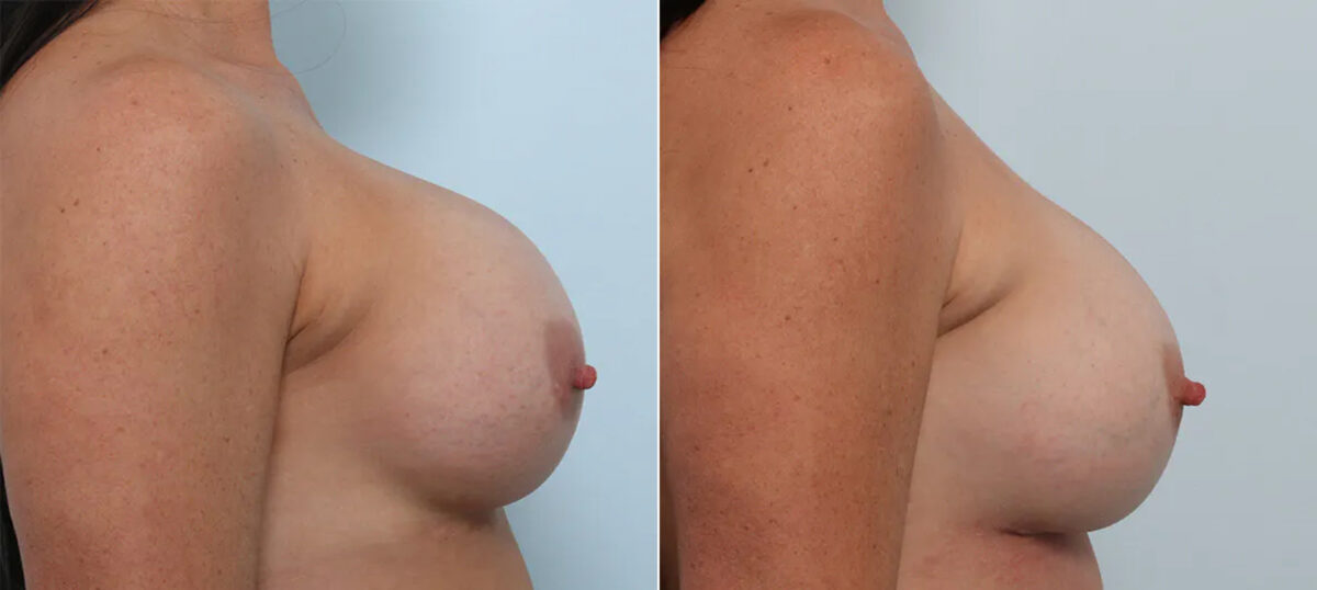 Breast Revision with Strattice before and after photos in Houston, TX, Patient 70648