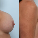 Breast Revision with Strattice before and after photos in Houston, TX, Patient 70648