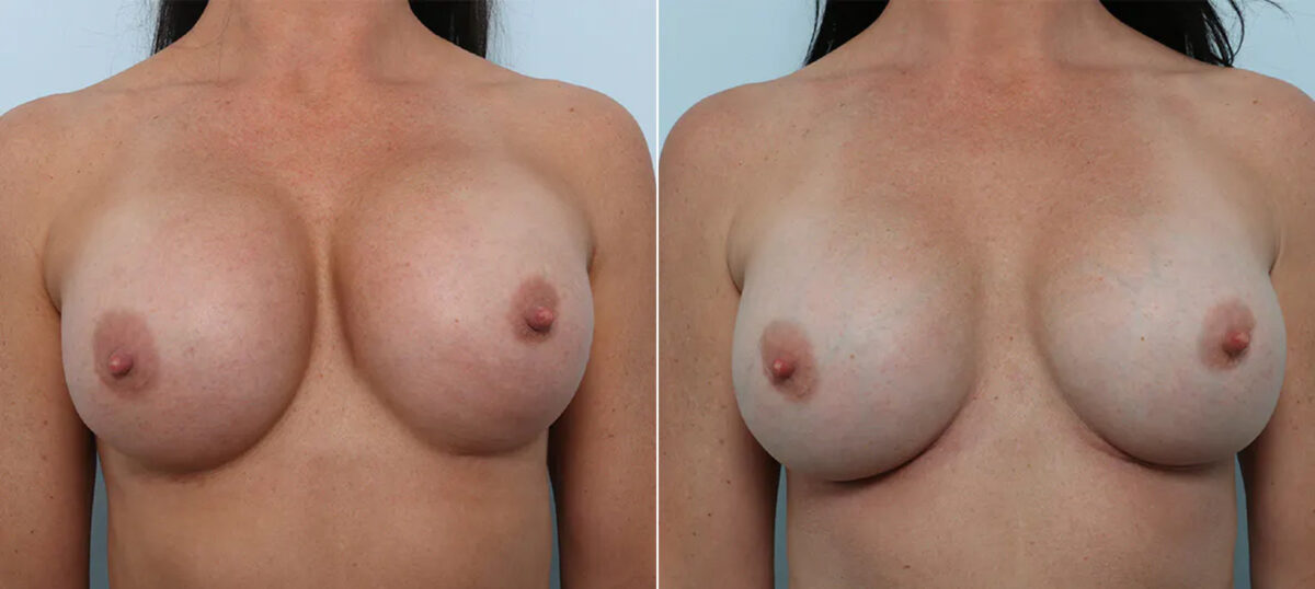 Breast Revision with Strattice before and after photos in Houston, TX, Patient 70648