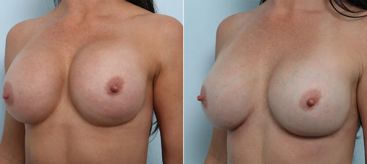 Breast Revision with Strattice before and after photos in Houston, TX, Patient 70648