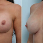 Breast Revision with Strattice before and after photos in Houston, TX, Patient 70648