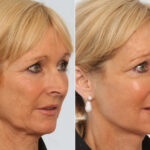 Facelift before and after photos in Houston, TX, Patient 70658