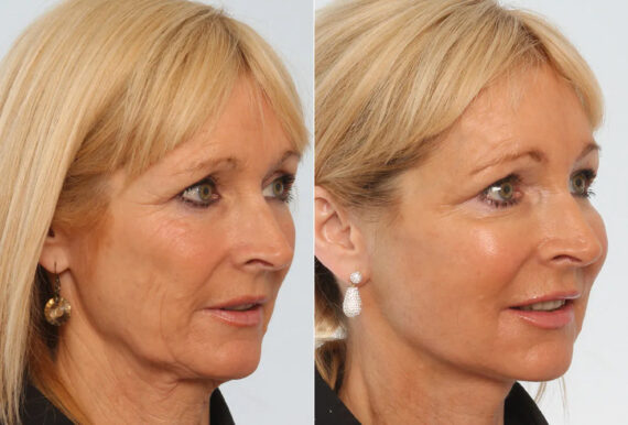 Facelift before and after photos in Houston, TX, Patient 70658