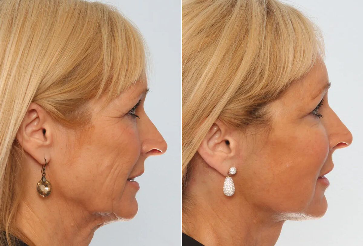 Facelift before and after photos in Houston, TX, Patient 70658