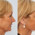 Facelift before and after photos in Houston, TX, Patient 70658