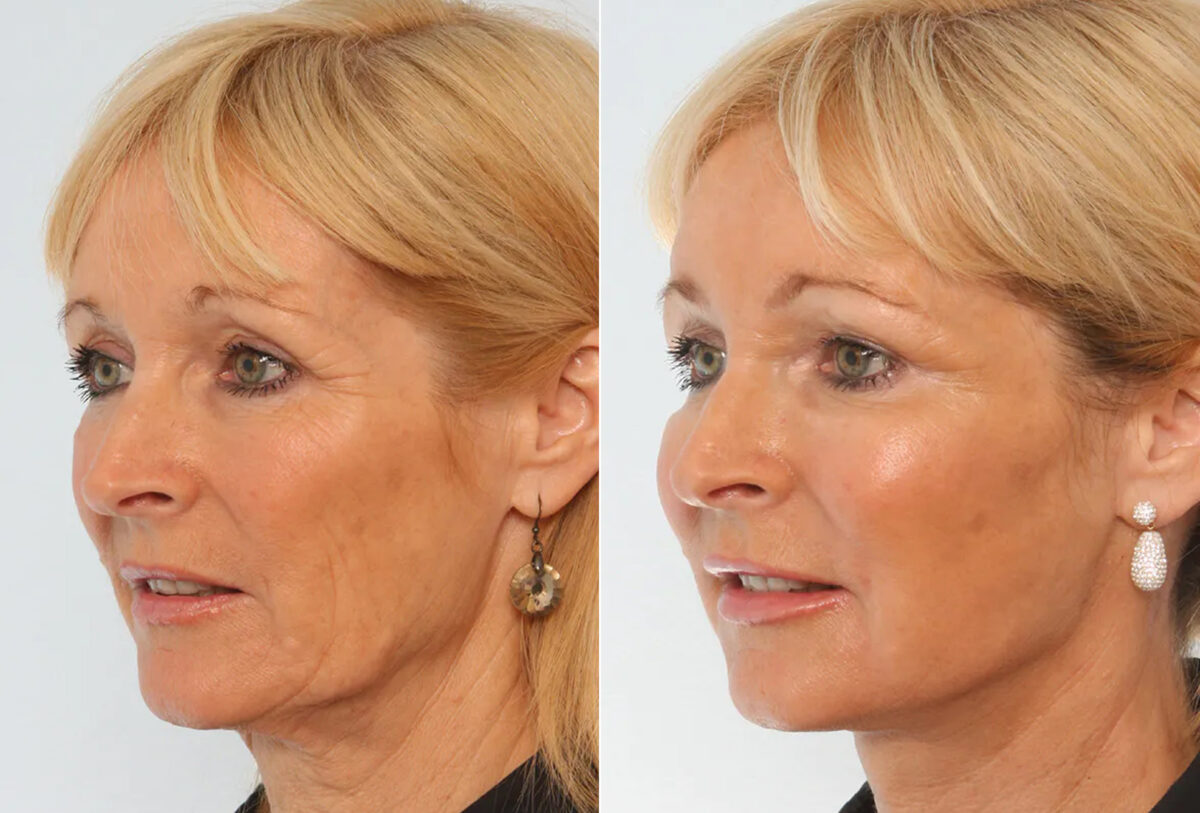 Facelift before and after photos in Houston, TX, Patient 70658