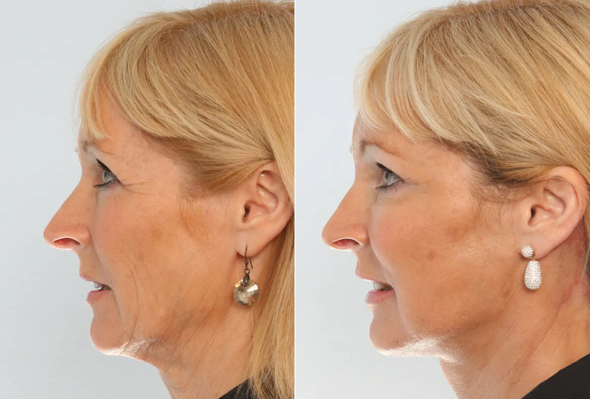 Facelift before and after photos in Houston, TX, Patient 70658