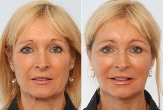 Facelift before and after photos in Houston, TX, Patient 70658