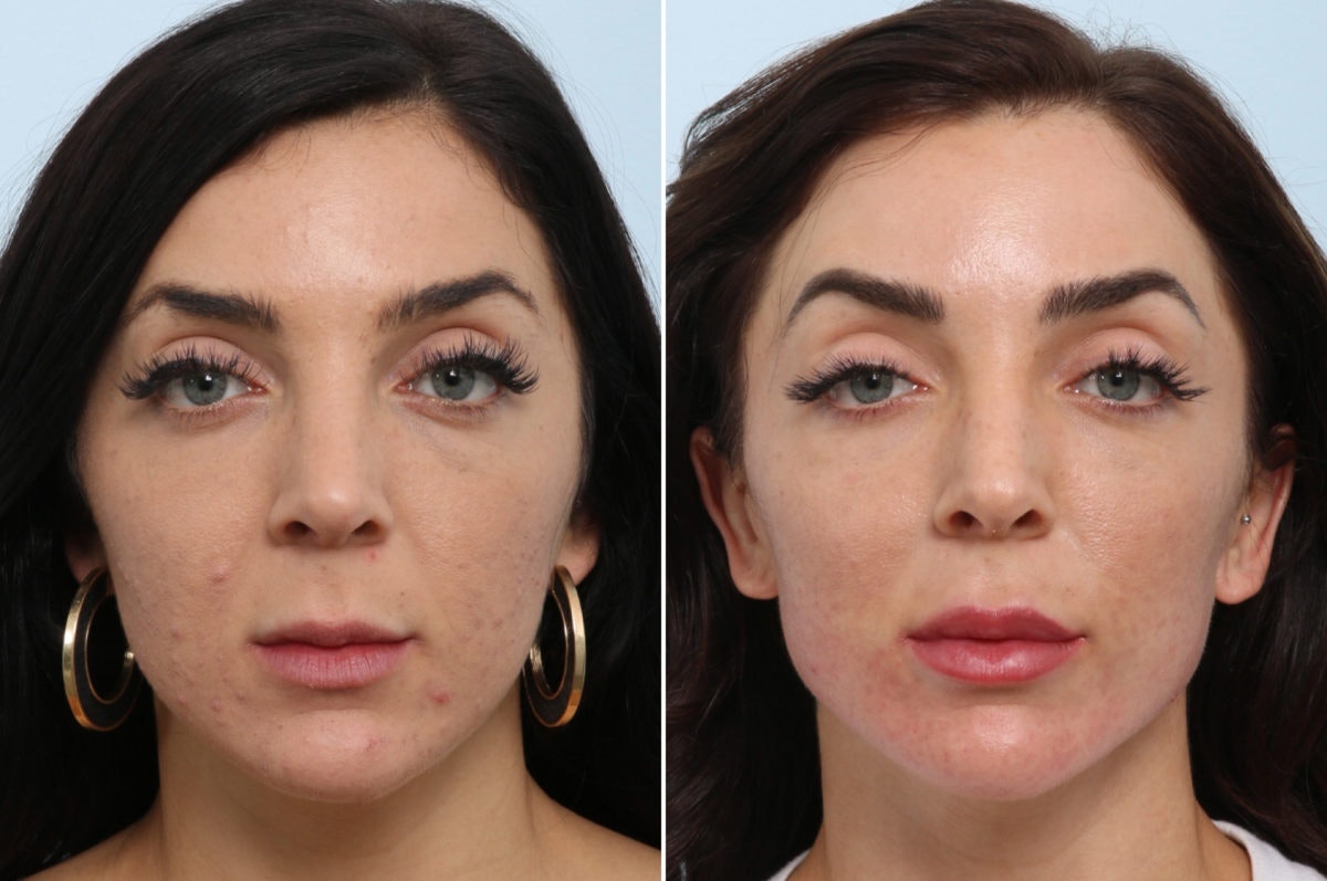 radiesse-before-after-dr-vitenas-houston-1