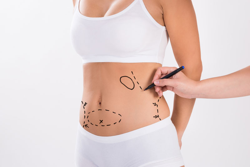 Liposuction Recovery: A Week by Week Guide - Omaha Liposuction by