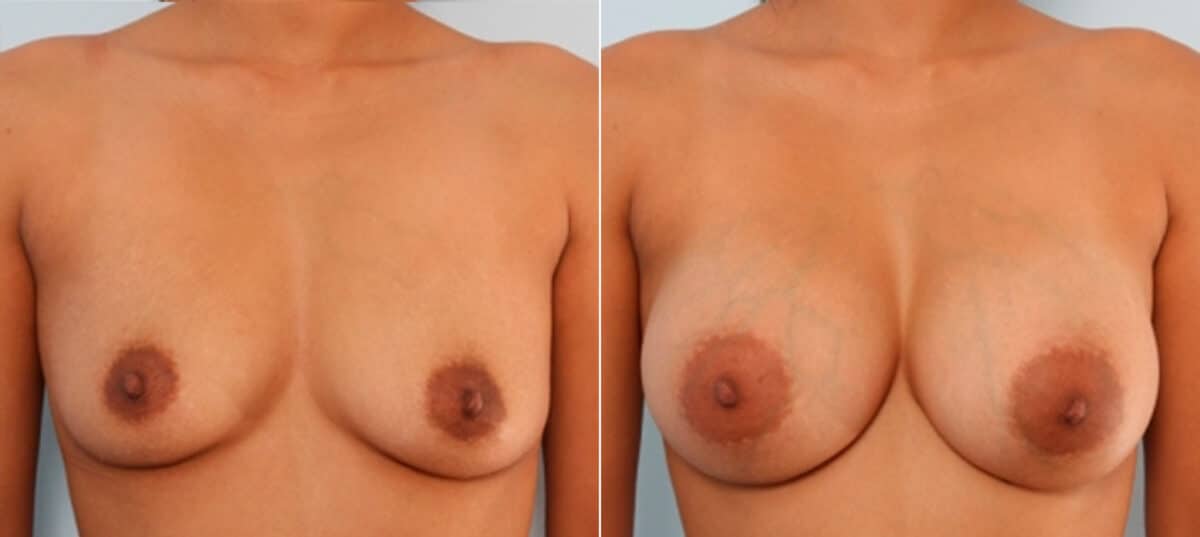 Breast Augmentation before and after photos in Houston, TX, Patient 24743