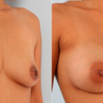 Breast Augmentation before and after photos in Houston, TX, Patient 24743