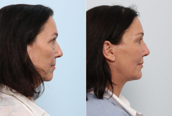 Facelift before and after photos in Houston, TX, Patient 77145