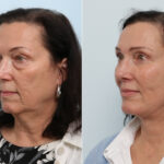 Facelift before and after photos in Houston, TX, Patient 77145