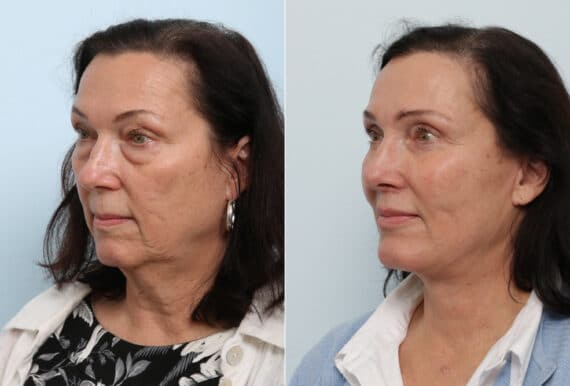 Facelift before and after photos in Houston, TX, Patient 77145