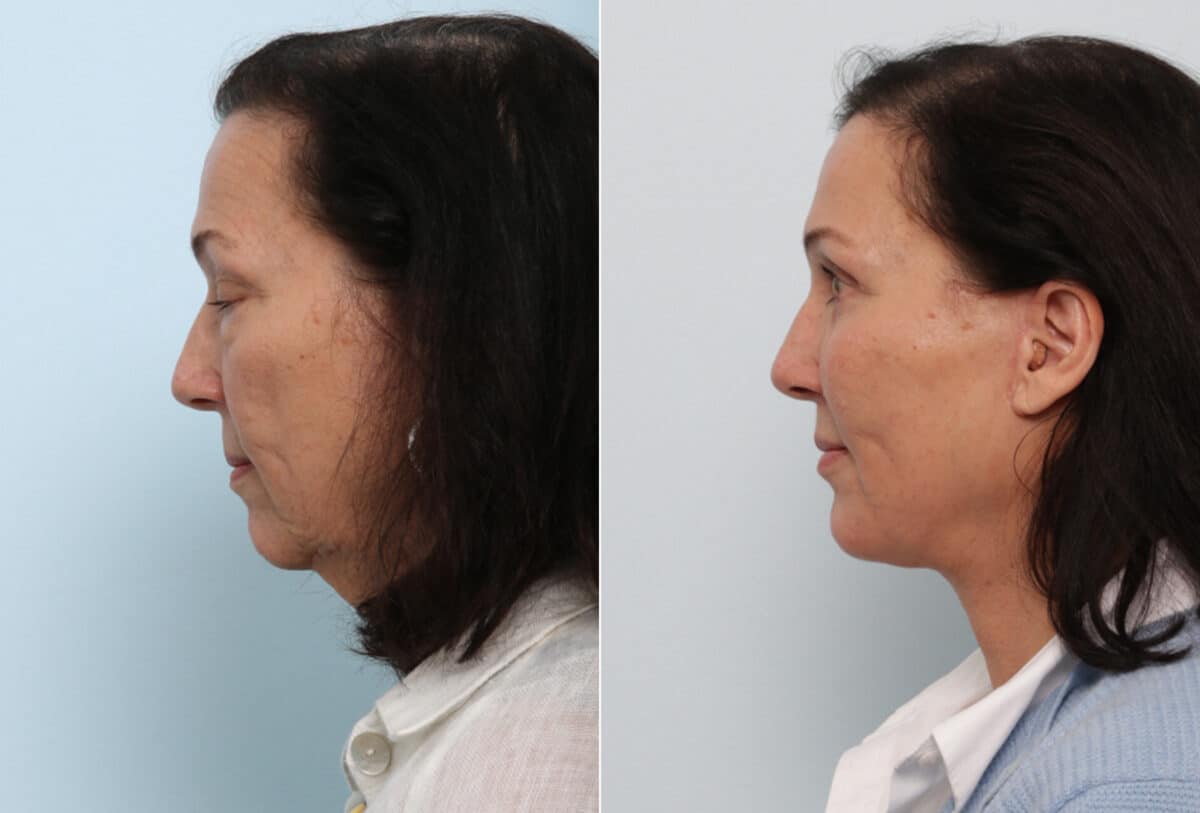 Facelift before and after photos in Houston, TX, Patient 77145