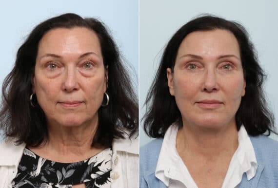 Facelift before and after photos in Houston, TX, Patient 77145