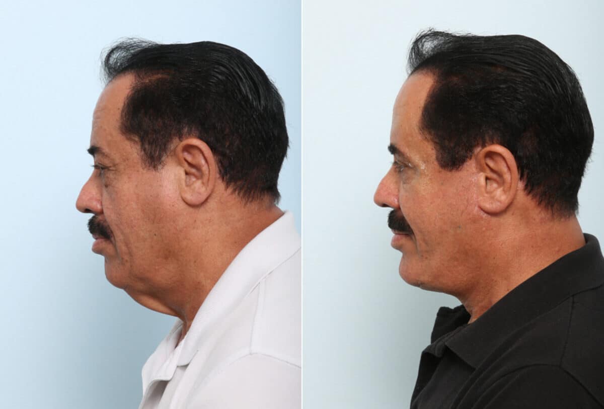 Facelift before and after photos in Houston, TX, Patient 77159