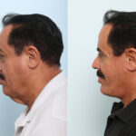 Facelift before and after photos in Houston, TX, Patient 77159