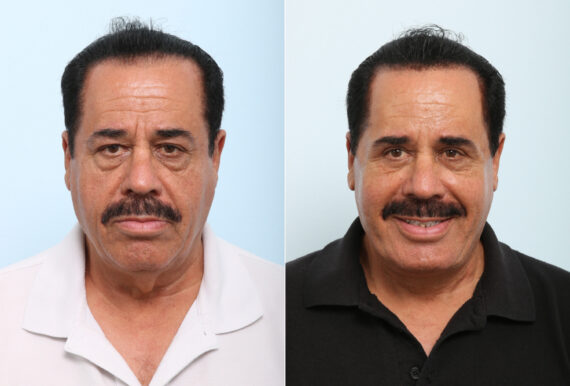 Facelift before and after photos in Houston, TX, Patient 77159