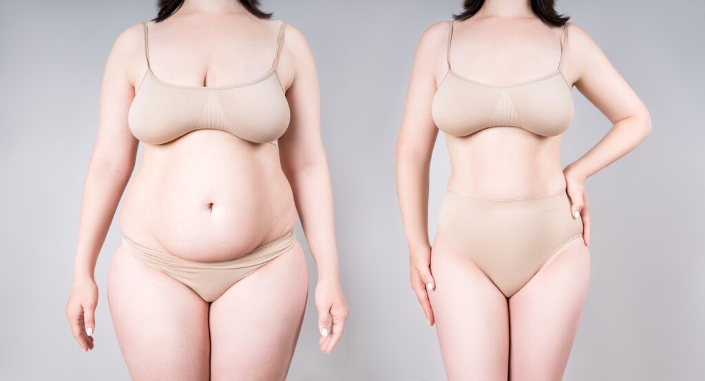 Keep Skin from Sagging After Liposuction - Blog
