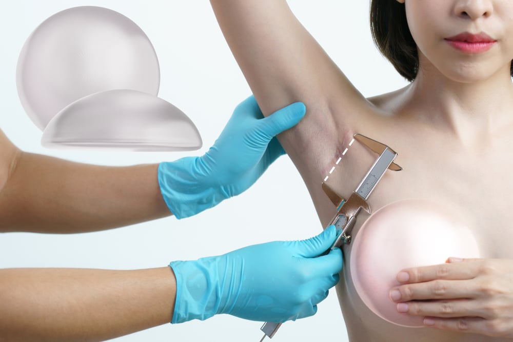 Breast Explant and Lift for Breast Surgery Complications