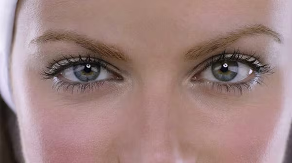 Women eyes after Blepharoplasty Recovery