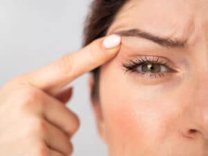 blepharoplasty patient after upper and lower surgery