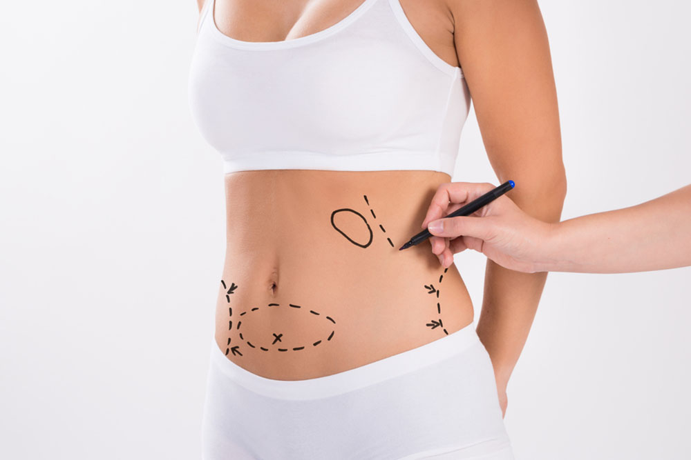 Liposuction Recovery Pain Expectations