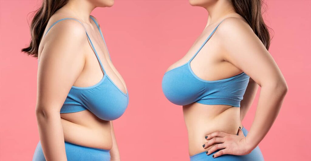Understanding the Difference Between a Breast Lift and Breast