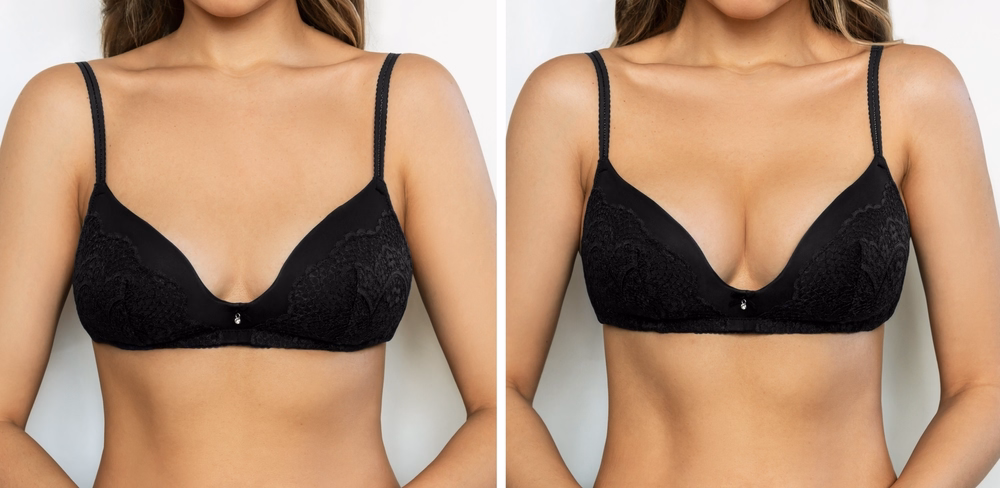 Breast implants provide a tailored approach to individual needs