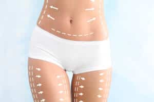 Different body lift procedures target specific areas of the body, such as the buttocks, thighs, or abdomen.