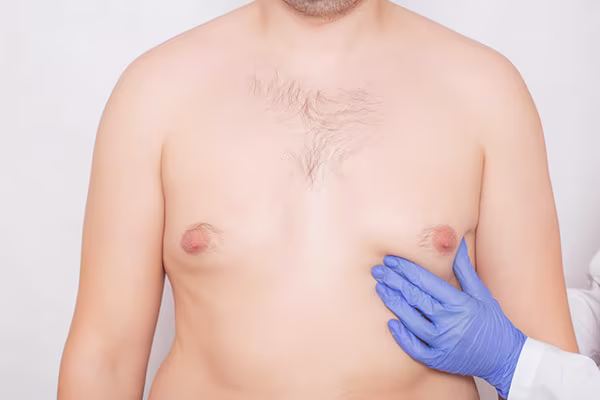 Gynecomastia surgery is a procedure designed to reduce the amount of excess breast tissue in men, giving them a flatter and more contoured chest.