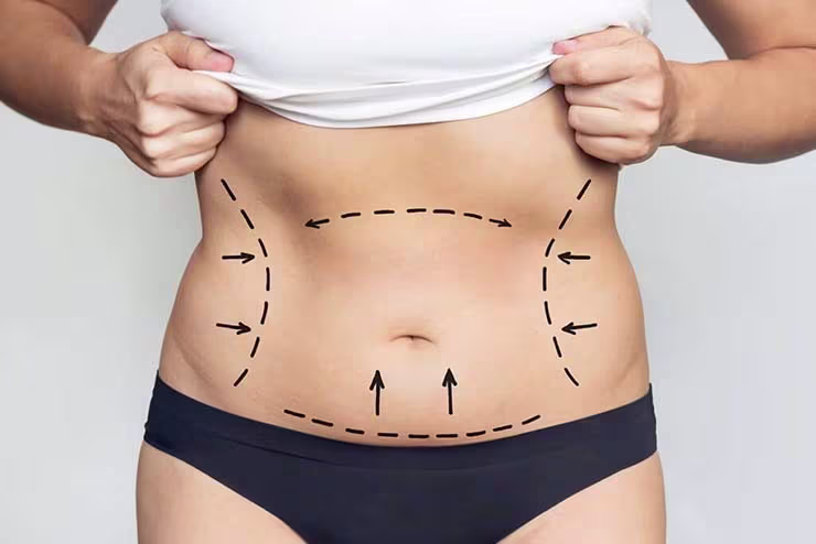 Patience is crucial during a mommy makeover recovery, as full healing can take several weeks to months