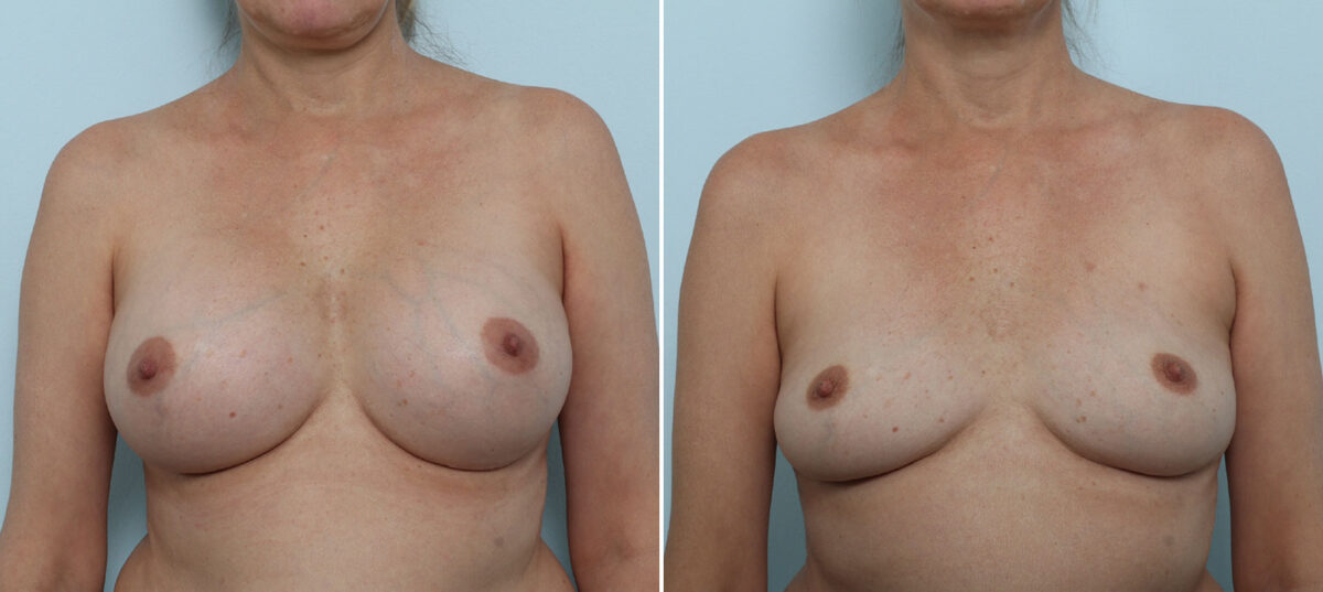 Breast Implant Removal before and after photos in Houston, TX, Patient 79301