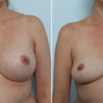 Breast Implant Removal before and after photos in Houston, TX, Patient 79301