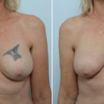 Breast Implant Removal before and after photos in Houston, TX, Patient 79314