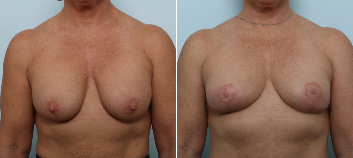 Breast Implant Removal before and after photos in Houston, TX, Patient 79316