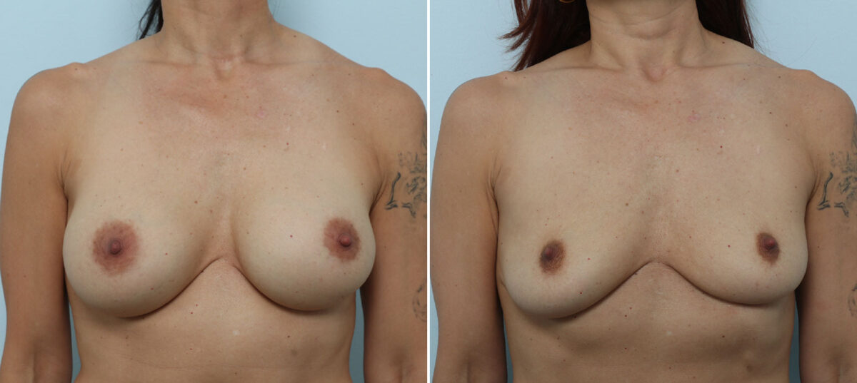 Breast Implant Removal before and after photos in Houston, TX, Patient 79318
